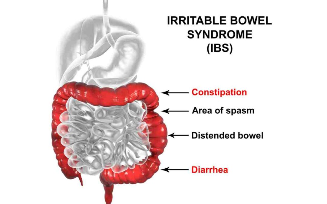 Irritable Bowel Syndrome (lBS)
