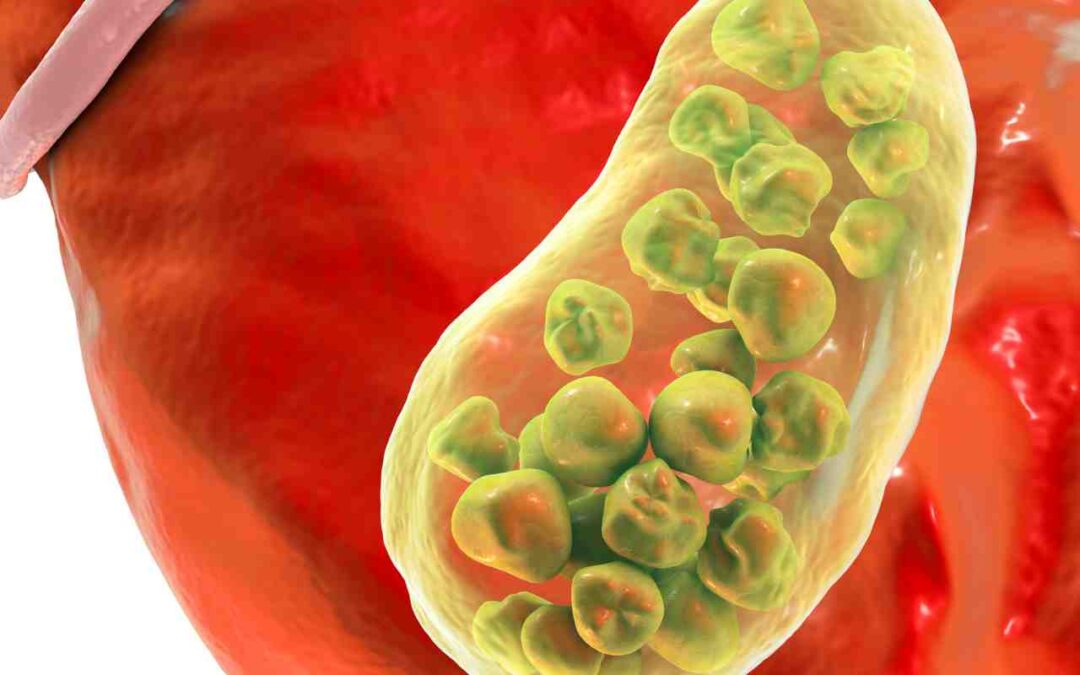 The amazing liver and gallbladder flush