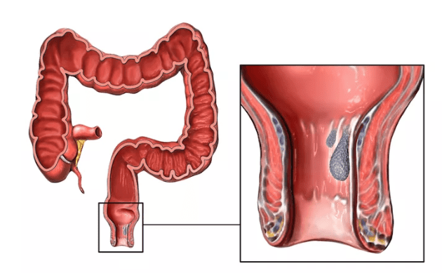 Blood in the anus / intestines: what does it mean?