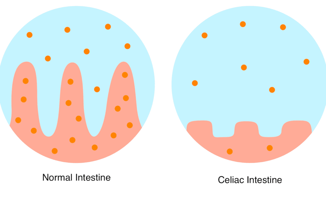 What is Celiac Disease?