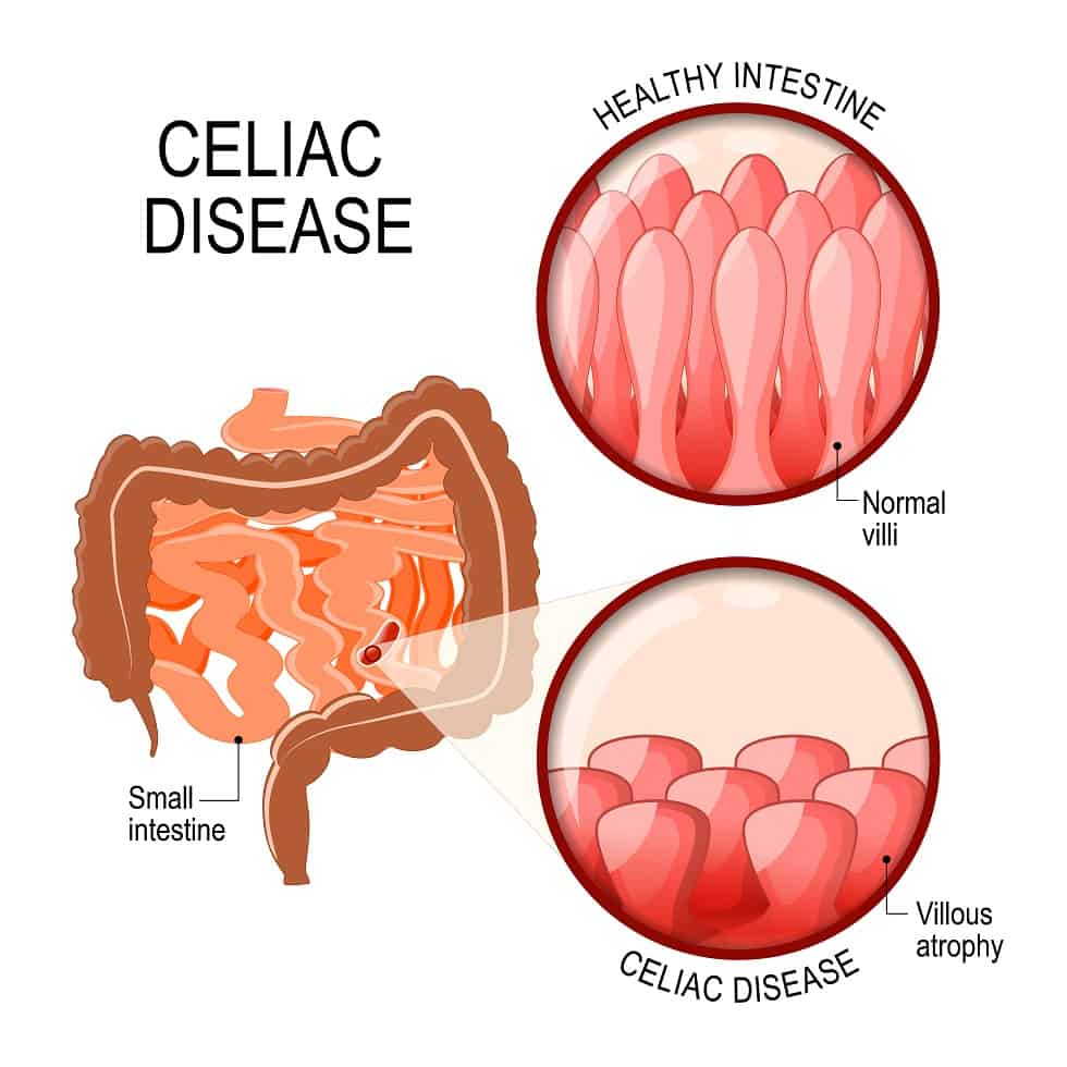 Celiac Disease