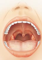 Inflamed tonsils