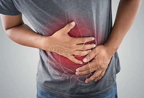 Crohn’s disease: symptoms, causes, therapy