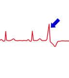 An extrasystole on the EKG