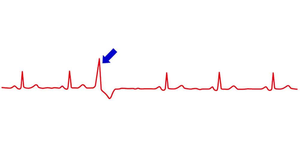 Irregular heartbeat (arrhythmias)