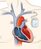 Sometimes the solution--a pacemaker