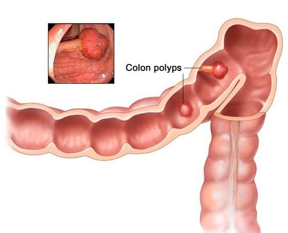 Colon polyps: causes, risks, treatment