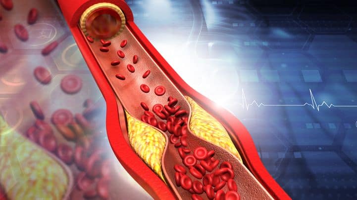 Clean arteries – prevent arteriosclerosis